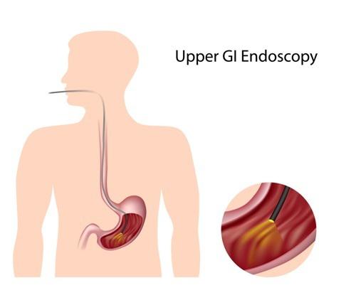upper endoscopy