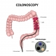 a diagram of a colonoscopy